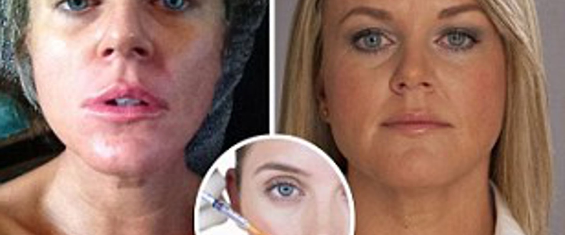 Are Face Fillers Safe? An Expert's Perspective