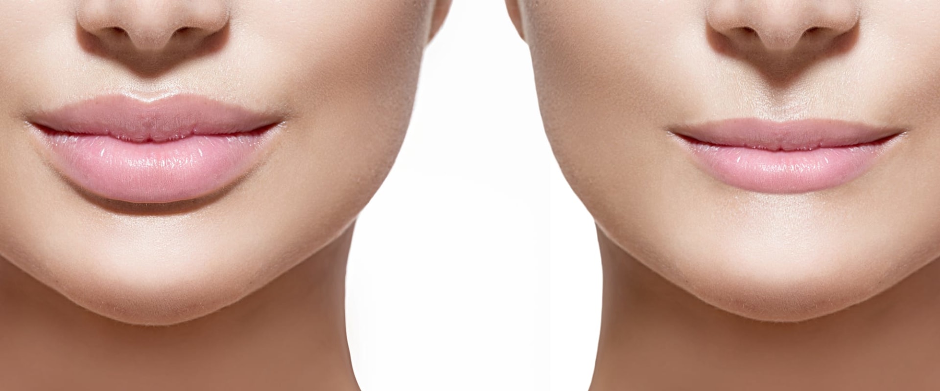 How Long Do Dermal Fillers Last? An Expert's Guide