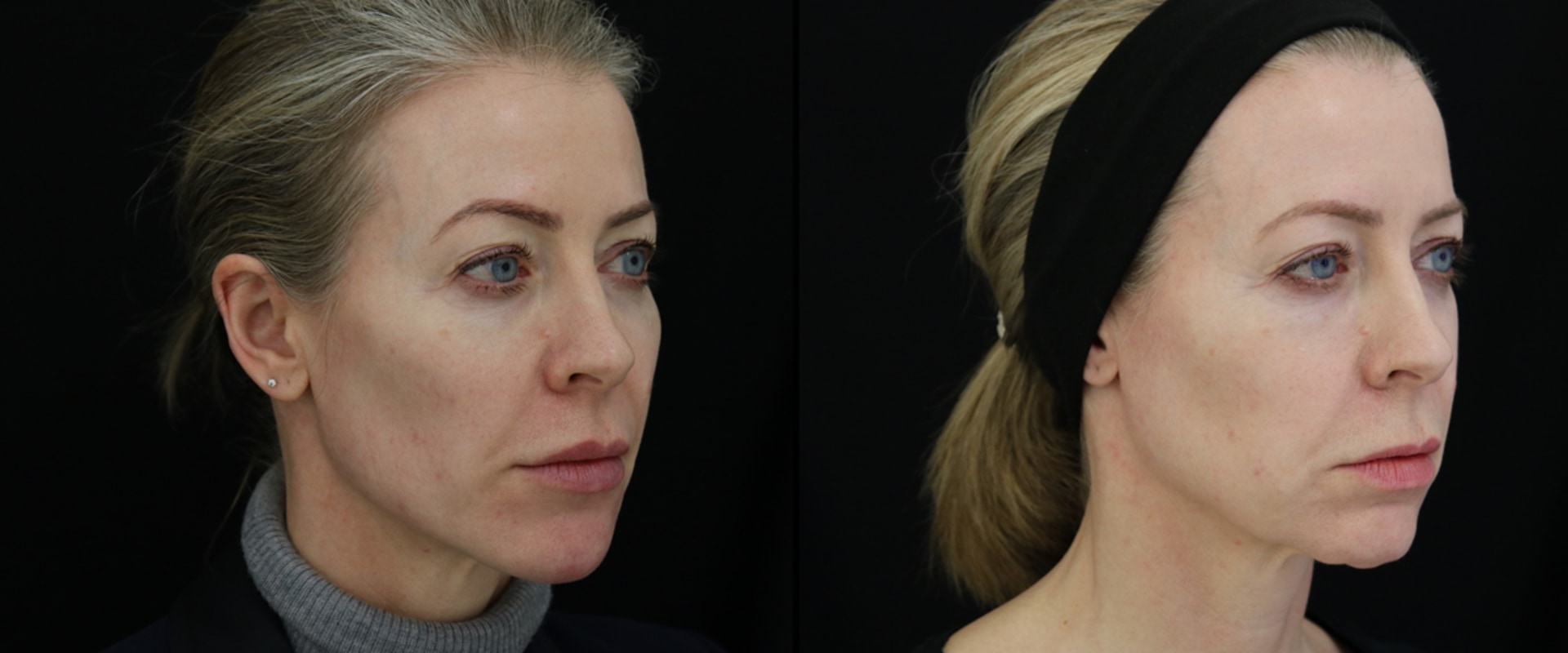 How Much Filler is Needed to Enhance Hollow Cheeks?