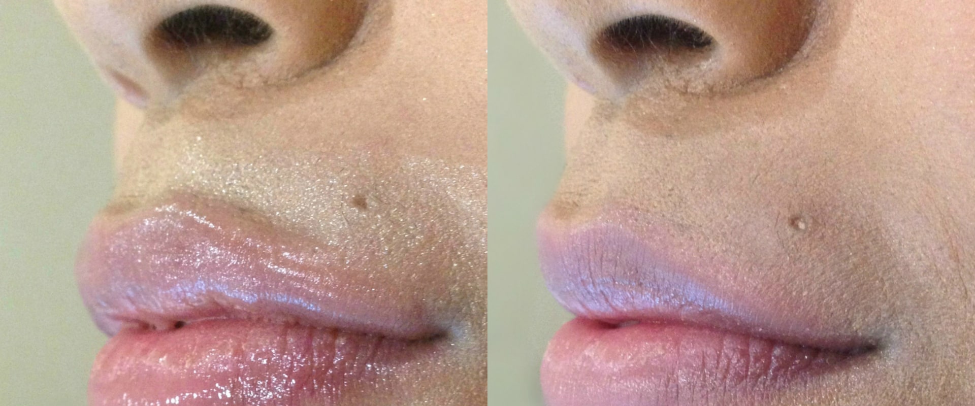 How Much Does a Syringe of Lip Filler Cost?