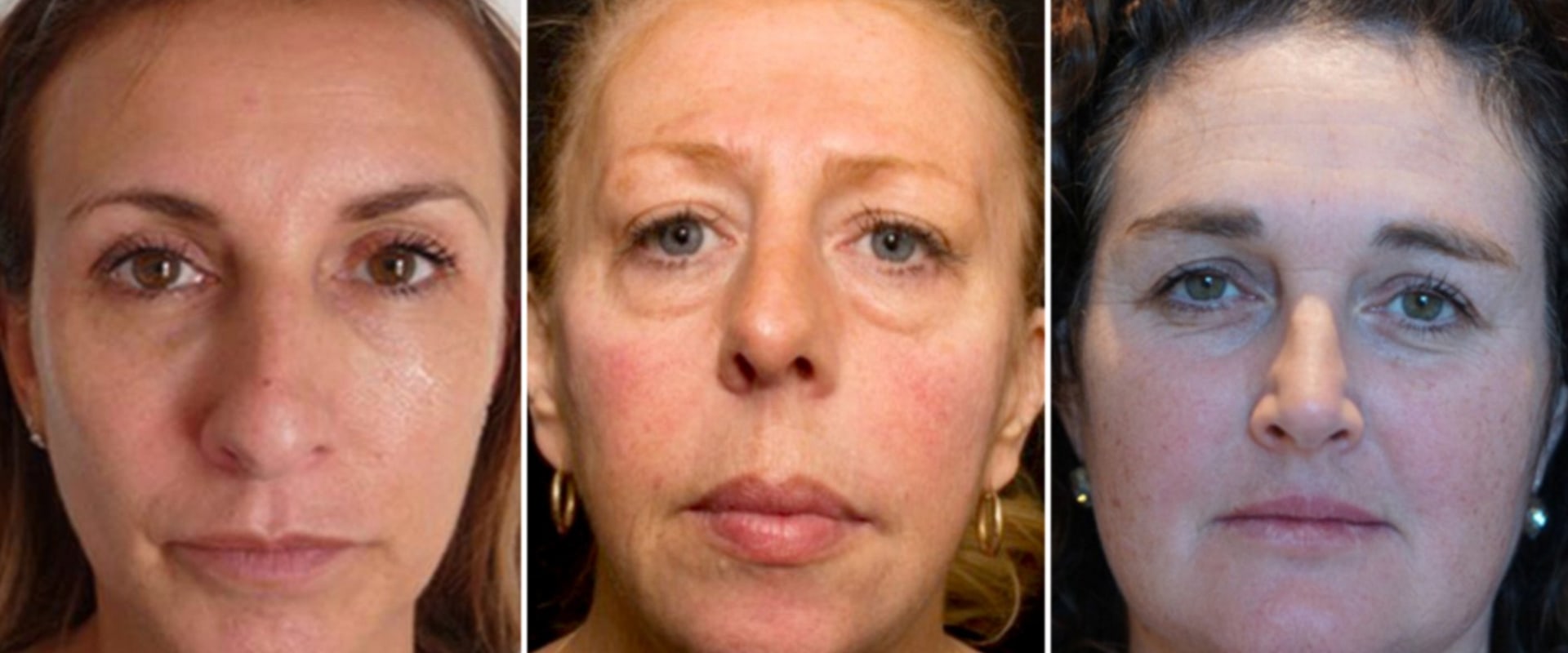 What Happens to Dermal Fillers After Years of Use?