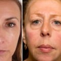 How Long Do Dermal Fillers Last?