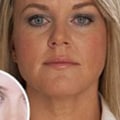 Are Face Fillers Safe? An Expert's Perspective