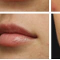 Do Lip Fillers Go Down After the First Day?