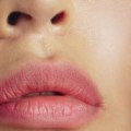 Dissolving Filler Naturally: What You Need to Know