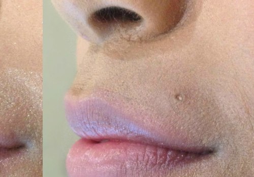 How Much Does a Syringe of Lip Filler Cost?
