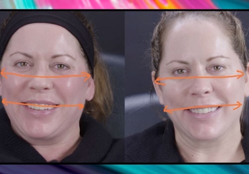 Do Fillers Change the Look of Your Face?