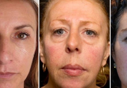 What Happens to Dermal Fillers After Years of Use?