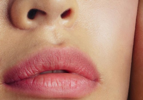 Dissolving Filler Naturally: What You Need to Know